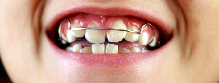 Ne Zaman Bir Ortodonti Uzmanına Görünmelisiniz?
