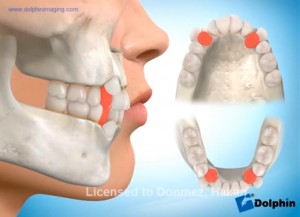 Ortodontide Diş Çekimi