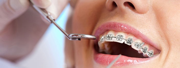 Yetişkinlerde ortodontik tedavi
