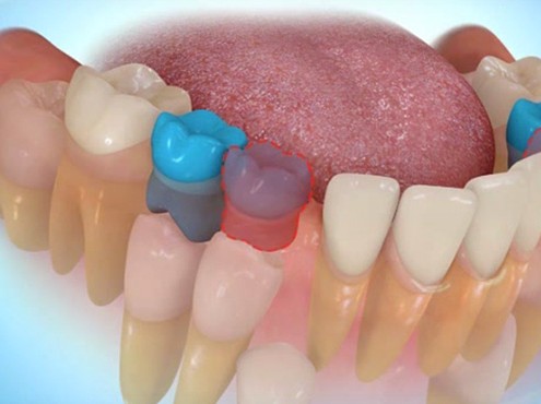 Ortodontik Tedavi için Diş Çekimi
