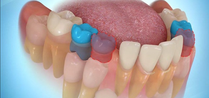 Ortodontik Tedavi için Diş Çekimi