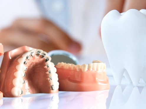 Çarpık, yamuk diş tedavisi ile dişler nasıl düzeltilir?